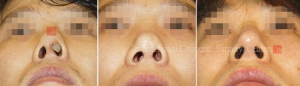 	Protruded Mouth Correction Rhinoplasty, Contracted Nose, Revision Rhinoplasty	 - Silicone showing/infection