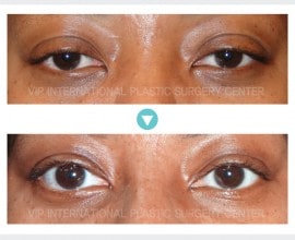 Ptosis Correction