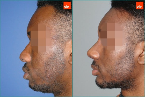Nose Surgery - Rib cartilage rhinoplasty, Forehead endoscope, Genioplasty