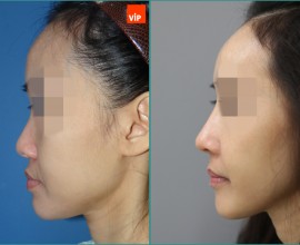 Rhinoplasty