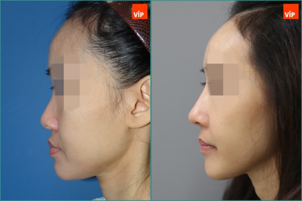 Nose Surgery - Rhinoplasty