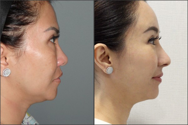 Nose Surgery, Eye Surgery, Face Lift, Stem Cell Fat Graft - Rib cartilage, Endoscopic Forehead, Fat graft, eye