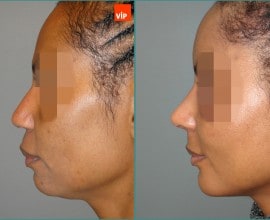 Rib cartilage rhinoplasty