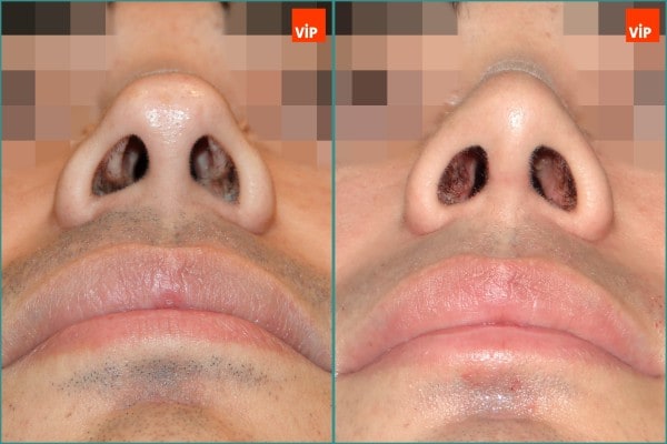 Nose Surgery - Septal cartilage rhinoplasty, Septal Deviation, Long Nose