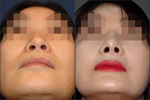 Nose Surgery - Rib cartilage rhinoplasty