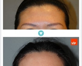 Endoscopic Forehead Lift