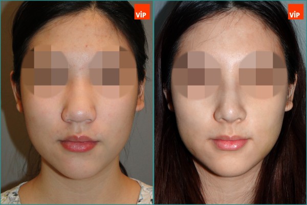 Nose Surgery - Rib cartilage rhinoplasty