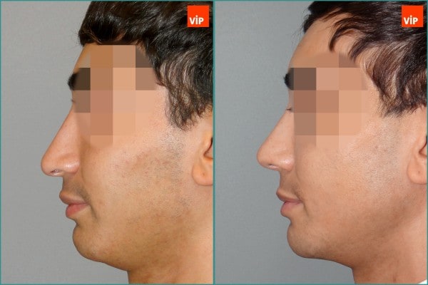 Nose Surgery - Septal cartilage rhinoplasty, Septal Deviation, Long Nose