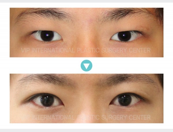 Eye Surgery - Male Ptosis Correction