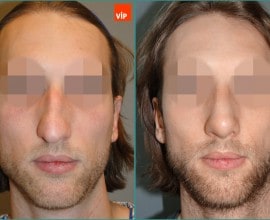 Septal cartilage rhinoplasty