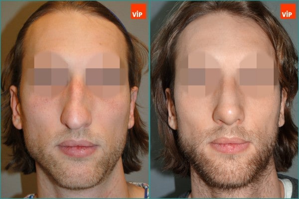 Nose Surgery - Septal cartilage rhinoplasty