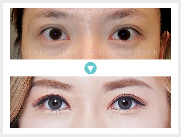 Eye Surgery - Eye correction