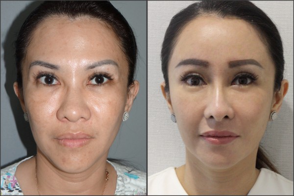 Nose Surgery, Eye Surgery, Face Lift, Stem Cell Fat Graft - Rib cartilage, Endoscopic Forehead, Fat graft, eye