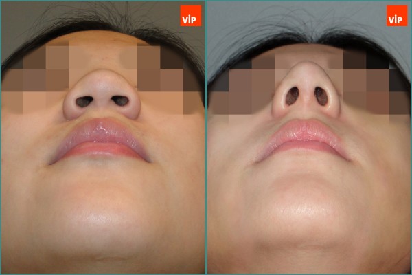 Nose Surgery - Rib cartilage rhinoplasty