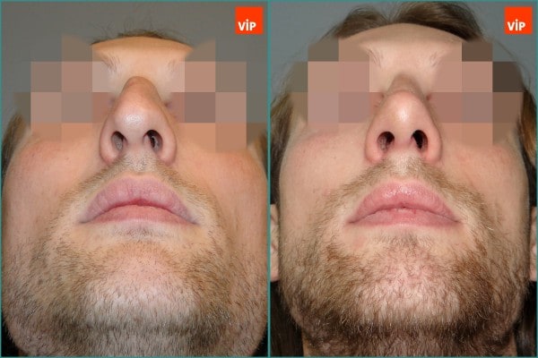 Nose Surgery - Septal cartilage rhinoplasty