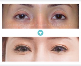 Ptosis Correction, Fat graft