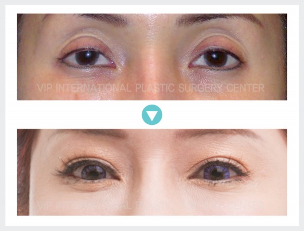 Eye Surgery, Stem Cell Fat Graft - Ptosis Correction, Fat graft