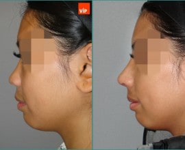 Rib cartilage rhinoplasty