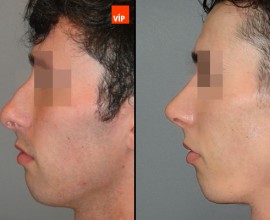 Septal Cartilage Rhinoplasty