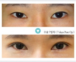 Eyelid surgery