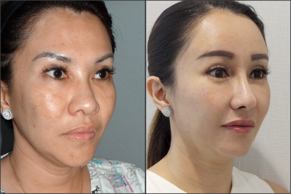 Nose Surgery, Eye Surgery, Face Lift, Stem Cell Fat Graft - Rib cartilage, Endoscopic Forehead, Fat graft, eye