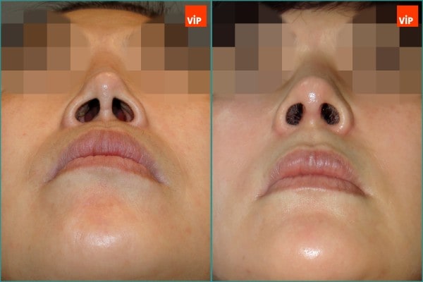 Nose Surgery, Face Lift - Rib cartilage rhinoplasty
