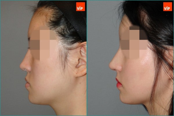 Nose Surgery - Rib cartilage rhinoplasty