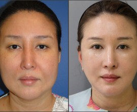 facelift , septal rhinoplasty