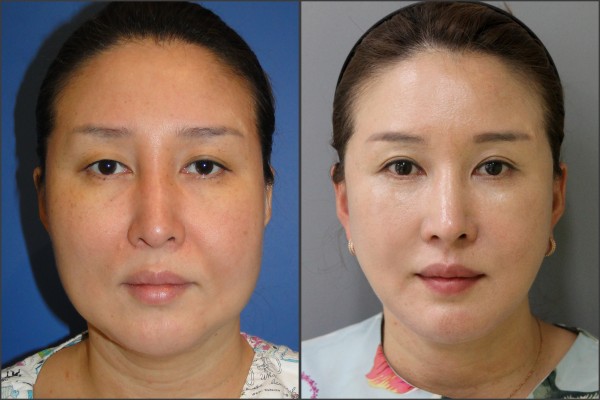 Nose Surgery, Eye Surgery, Face Lift - facelift , septal rhinoplasty