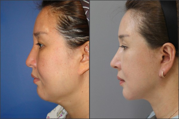 Nose Surgery, Eye Surgery, Face Lift - facelift , septal rhinoplasty