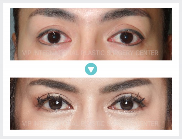 Eye Surgery - Ptosis Correction