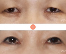 Double Eyelid Surgery