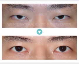 Male eyelid surgery