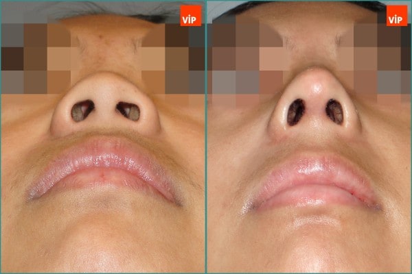 Nose Surgery - Rib cartilage rhinoplasty