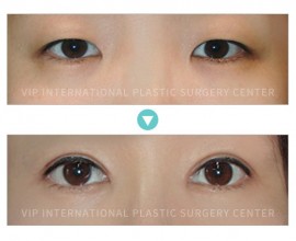 Double Eyelid Surgery