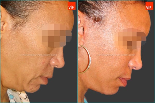 Face Lift - Neck lifting