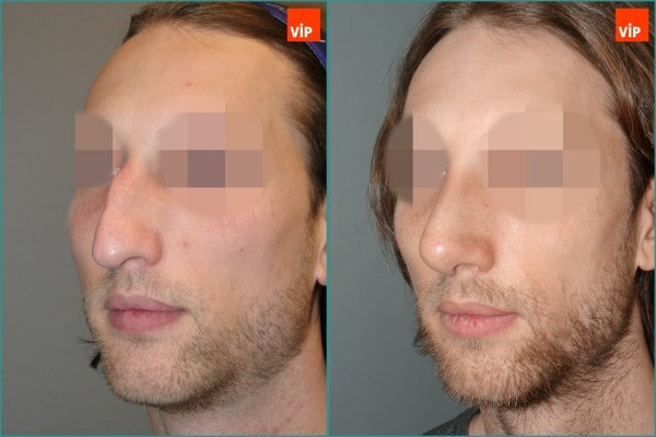 Nose Surgery - Septal cartilage rhinoplasty