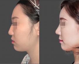 Septal rhinoplasty, Fat graft