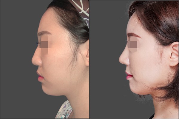 Nose Surgery, Stem Cell Fat Graft - Septal rhinoplasty, Fat graft