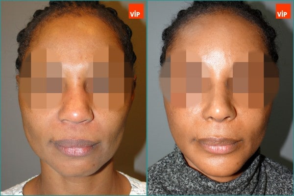 Nose Surgery - Rib cartilage rhinoplasty