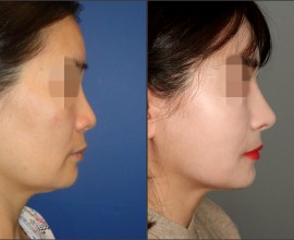 Rib cartilage rhinoplasty