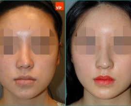 Rib cartilage rhinoplasty