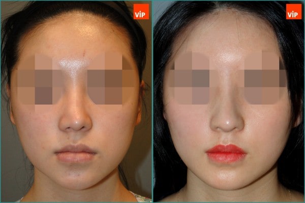 Nose Surgery - Rib cartilage rhinoplasty