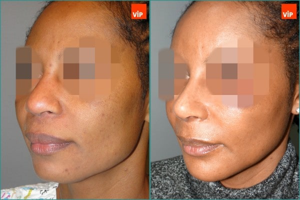 Nose Surgery - Rib cartilage rhinoplasty