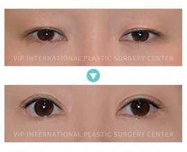 Double Eyelid Surgery