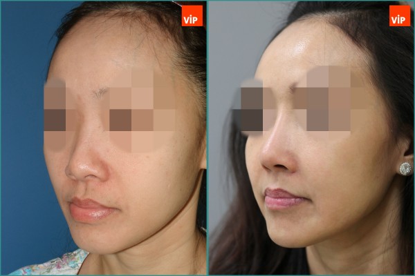 Nose Surgery - Rhinoplasty