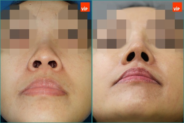 Nose Surgery - Rhinoplasty