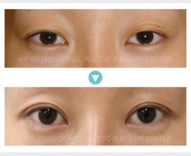 Ptosis Correction