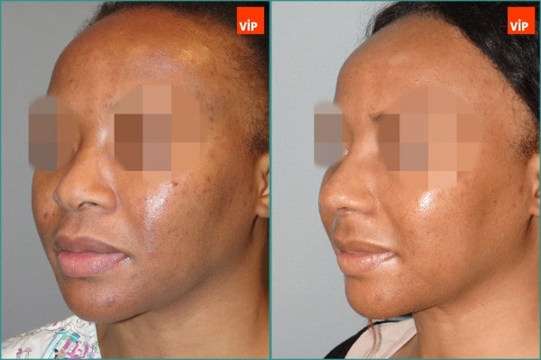 Nose Surgery - Rib cartilage rhinoplasty, Mid face augmentation, Ethnic Rhinoplasty