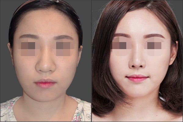 Nose Surgery, Stem Cell Fat Graft - Septal rhinoplasty, Fat graft